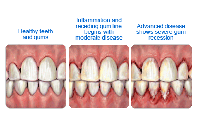 Pictuer showing healthy vs. diseased gums