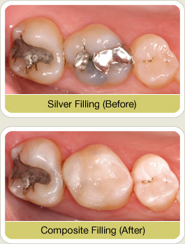 pre and post white filling pictures