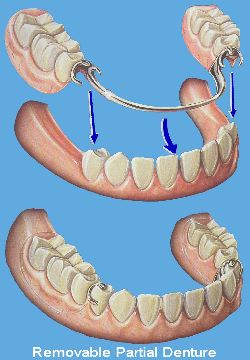 image of partial denture