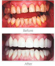 image of teeth without and with veneers